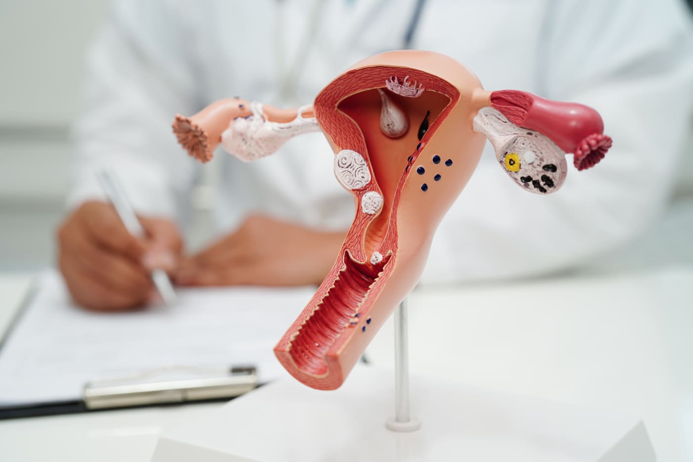 Endometriozis Çocuk Sahibi Olmaya Engel mi? Tüp Bebek Tedavisi Ne Zaman Gündeme Gelir?